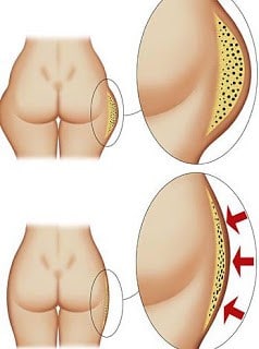 Come prevenire la cellulite